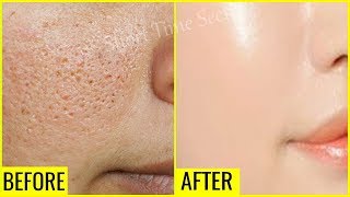 In Just 3 Days Reduce Large OPEN PORES Permanently  OPEN PORES Treatment [upl. by Ttimme]