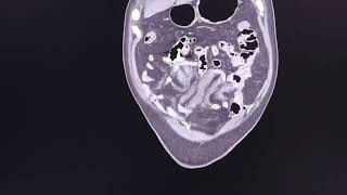 Mesenteric haematoma spontaneous  CT findings [upl. by Giah]