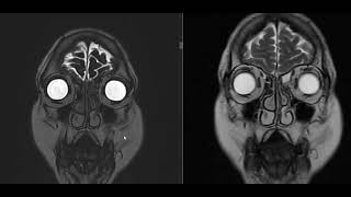 49 year female with left orbital pain [upl. by Animehliw146]