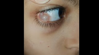 Hidden Swelling in eyes 👀  condition explained indetail eyecareoptom5506 eye eyelid swelling [upl. by Napra]