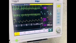 Taquicardia Supraventricular Paroxistica TSVP [upl. by Vigen119]