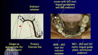 DENT 718 Removable partial dentures design considerations [upl. by Niliram]