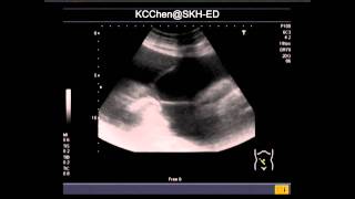 Sclerosing Encapsulating Peritonitis [upl. by Hoehne]