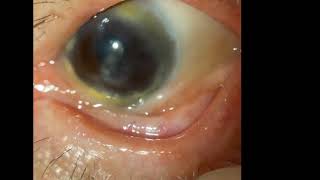 Ocular Cicatricial Pemphigoid [upl. by Lynna]