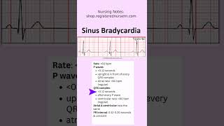 Sinus Bradycardia ECG EKG Nursing Treatment Rhythm Made Easy in Less Than 1 Minutes nursing ecg [upl. by Eusassilem]