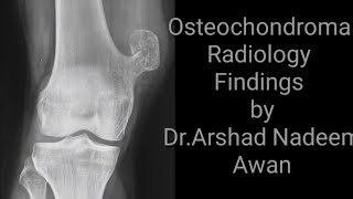 Osteochondroma Radiology x rays and CT images [upl. by Edya]