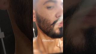 1 ANO USANDO MINOXIDIL evolução minoxidil minoxidil barba [upl. by Astera]