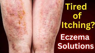 Dermatologist’s Guide to Beating Eczema [upl. by Bluhm]