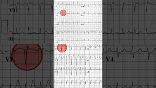 AVNRT ECG Example [upl. by Lozano949]