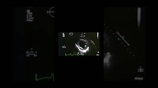 This Is What Atrial Fibrilation Looks Like On An Echocardiogram shorts [upl. by Gehman931]