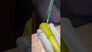 Achilles tendon repair physiotherpist surgery backpain cervicalpain comedy shorts [upl. by Nohsram637]