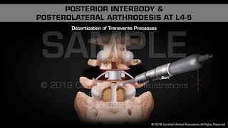 Posterior Interbody amp Posterolateral Arthrodesis at L45  Medical Animation [upl. by Anstus]