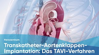 TranskatheterAortenklappenImplantation Das TAVIVerfahren [upl. by Ardnossac]