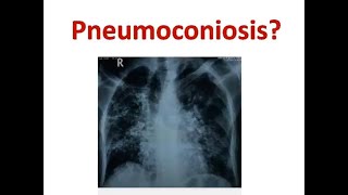 Pneumoconiosis on Chest XRay and CT Scan Chest [upl. by Anelec]