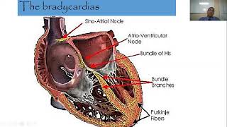 Cardiac Arrhythmias part1  Bradycardia [upl. by Kolb]