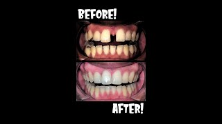 25 Years of BRACES in 40 seconds BEFORE AND AFTER Closing Large Teeth Gap🦷Shorts braces [upl. by Woo]