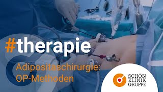 Adipositaschirurgie – Die OPMethoden  Schön Klinik Hamburg Eilbek [upl. by Eimmij727]