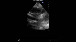 POCUS tamponade [upl. by Acissehc326]