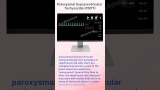 Paroxysmal Supraventricular Tachycardia PSVT [upl. by Assi]