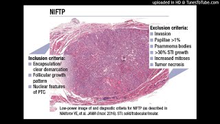 Noninvasive Follicular Neoplasm with Papillarylike Nuclear Features NIFTP [upl. by Jessabell]