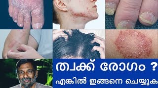 Psoriasis  Skin diseases treatment  Mohanan Vaidyar [upl. by Anohsal]