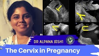 TMT The Cervix in Pregnancy by Dr Alpana Joshi [upl. by Nomrej382]