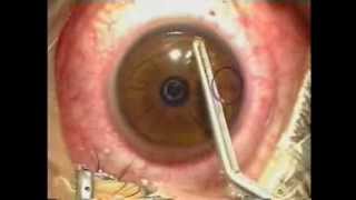 Lasik Laser Eye Surgery Procedure  Live Surgery [upl. by Niwri]