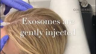 Exosomes for Hair Loss [upl. by Hansel]