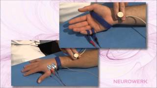 Sensory Neurography  Median Nerve [upl. by Yobybab]