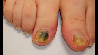 Ce remède de 3 Ingrédients élimine la mycose des ongles définitivementsanté c0ns3ils [upl. by Nalliuq133]