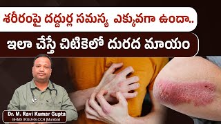 శరీరంపై దద్దుర్ల సమస్య ఎక్కువగా ఉందా  Skin Rashes Causes Symptoms amp Treatment  Social Post [upl. by Jodi502]