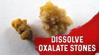 Why You Get Kidney Stones Oxalate Type – Removing Kidney Stones amp High Oxalate Foods – DrBerg [upl. by Onairotciv]