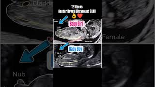 12 Weeks Gender Reveal Ultrasound Scan genderpredictions genderdetermination genderreveal [upl. by Katz393]