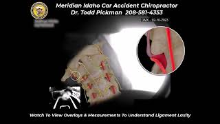 Digital Motion X Ray Normal Vs Spinal Ligament Injury with 2 S intro [upl. by Staw]