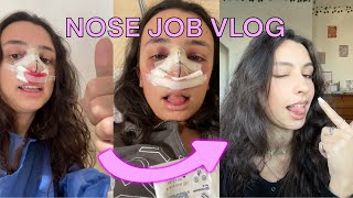 NOSE JOB and DEVIATED SEPTUM VLOG my septorhinoplasty recovery  tips [upl. by Ettenrahc]