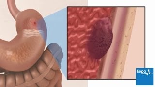 How a peptic ulcer develops  Bupa Health [upl. by Follansbee698]