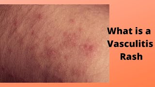 What is a Vasculitis Rash [upl. by Hermine]