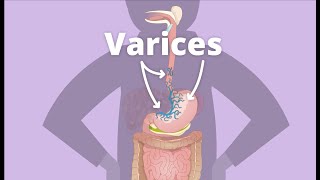 Cirrhosis – Varices [upl. by Oile]