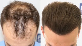 FUE Hair Transplant 3052 Grafts NW IIIVI Vertex By Dr Juan Couto  FUEXPERT CLINIC Madrid Spain [upl. by Nodnelg]