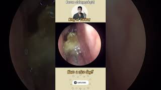 귀지형 콧물 부비동염 축농증 비염 코청소 이비인후과 rhinorrhea rhinitis sinusitis asmr ENT ENTdoctor [upl. by Hplodnar401]