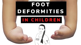 Foot deformities in children amp physiotherapy [upl. by Arakal]