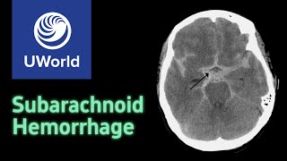 Subarachnoid Hemorrhage amp Treatment  nimodipine USMLE STEP 1 UWORLD Questions Nervous system [upl. by Nylinej]