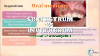 Sequestrum Vs Involucrum  Osteomyelitis  Oral Medicine  Dentophile [upl. by Kimble]