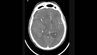 Intraparenchymal hemorrhage [upl. by Niuqauj]