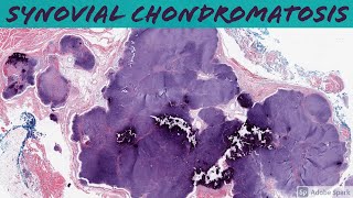 Synovial Chondromatosis 5Minute Pathology Pearls [upl. by Eeliak465]