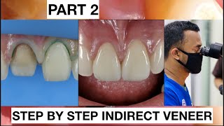 Step by Step 2 Indirect Veneer with Discoloration Tooth Part 2  General Dentist Griya RR [upl. by Poppas]