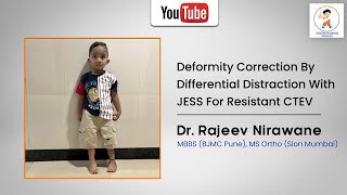 Deformity correction by differential distraction with JESS for resistant CTEV Done by Dr Nirawane [upl. by Keen]