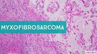 Myxofibrosarcoma 101Explained by a Sarcoma Pathologist [upl. by Sirrap]