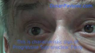 Progressive Supranuclear Palsy [upl. by Drawyeh873]