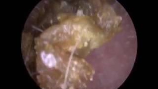 277  Ear Wax Removal Video of Completely Occluding amp Impacted Ear Wax on Eardrum [upl. by Langbehn]